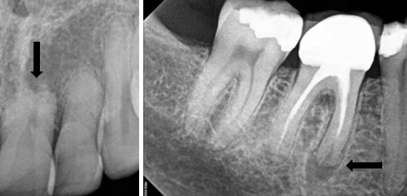 external resorption of tooth