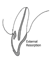 external resorption of tooth