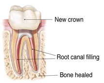 Temporary Filling VS Permanent Filling