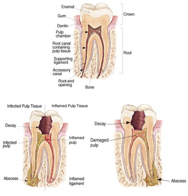 Root Canal Treatment - Advanced Endodontic Specialists